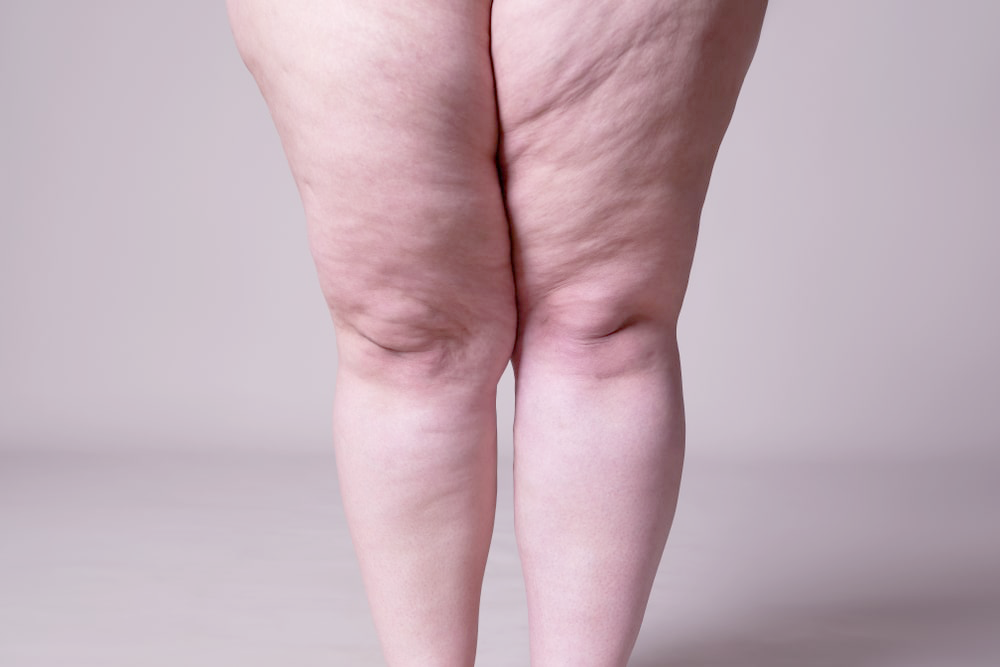 Cirugía de Lipedema en Galicia