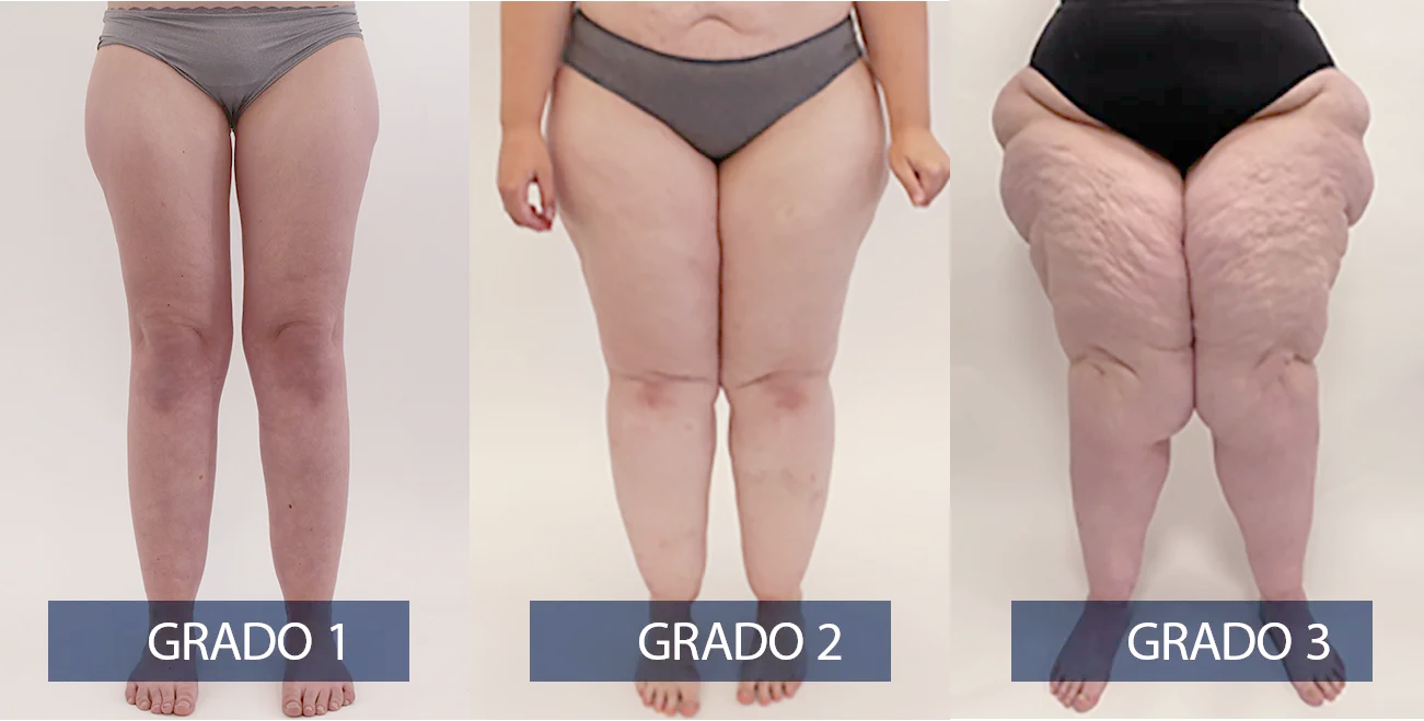 Cirugía de Lipedema en Galicia