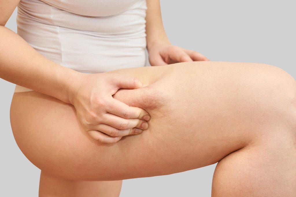 Cirugía de Lipedema en Galicia