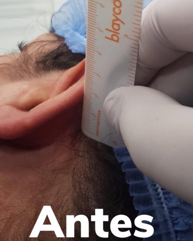 Otoplastia - antes
