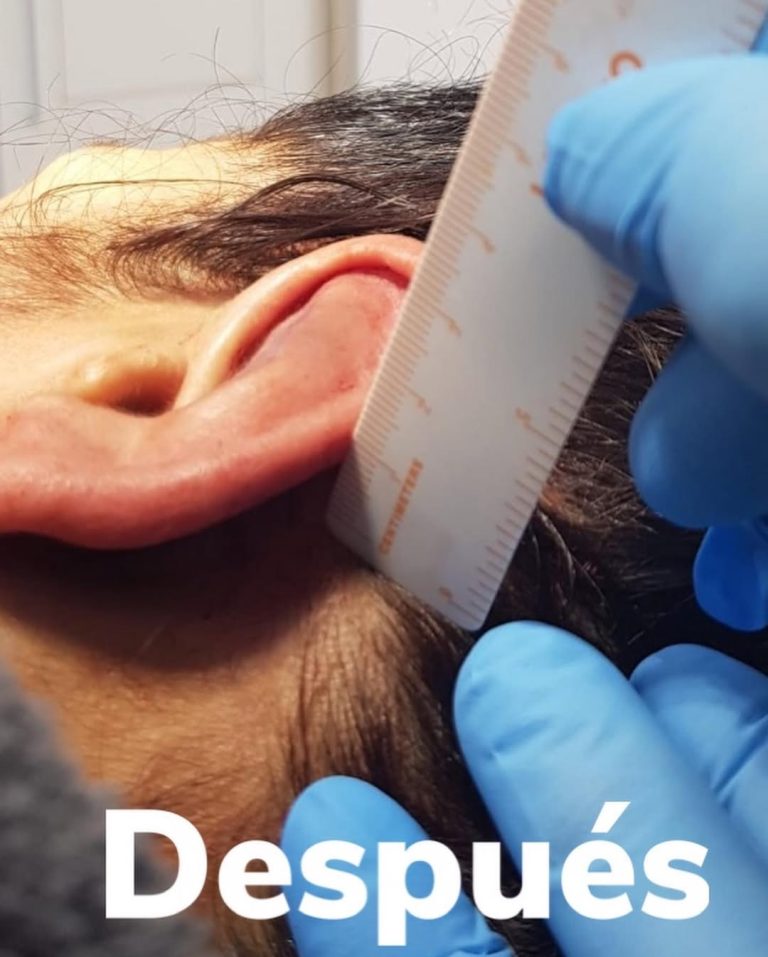 Otoplastia - después