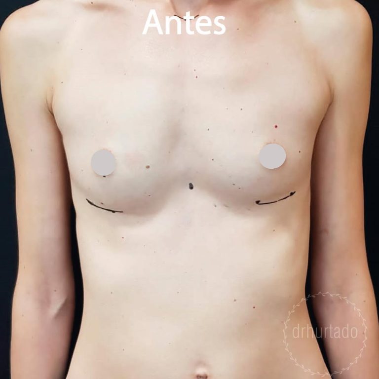 Aumento de Pecho