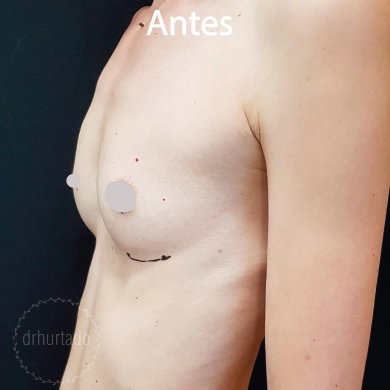 Mamoplastia de aumento de pechos - antes