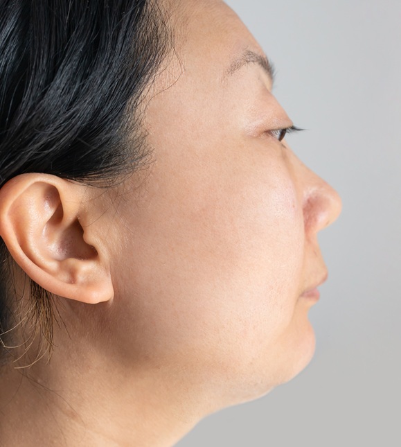 Lifting Facial