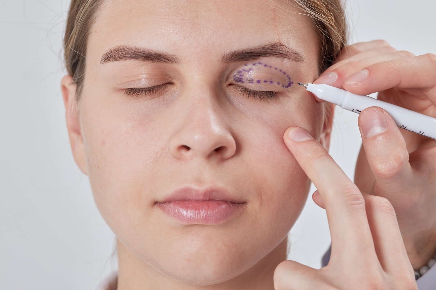 Blefaroplastia en Ourense