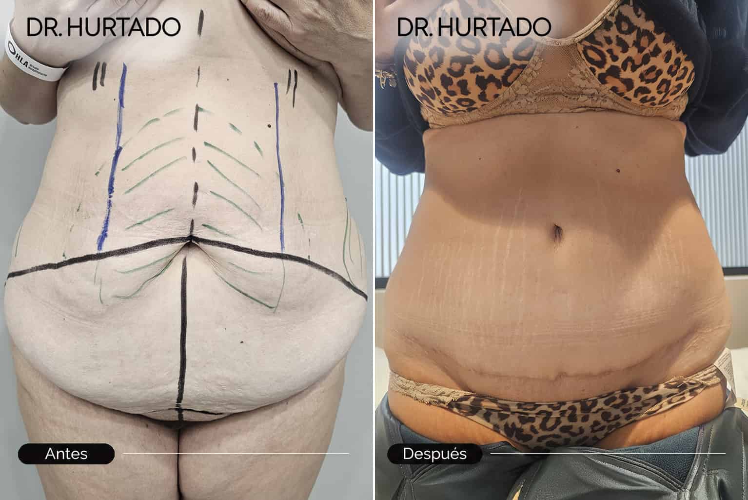 Especialista en cirugía de abdominoplastia en Galicia