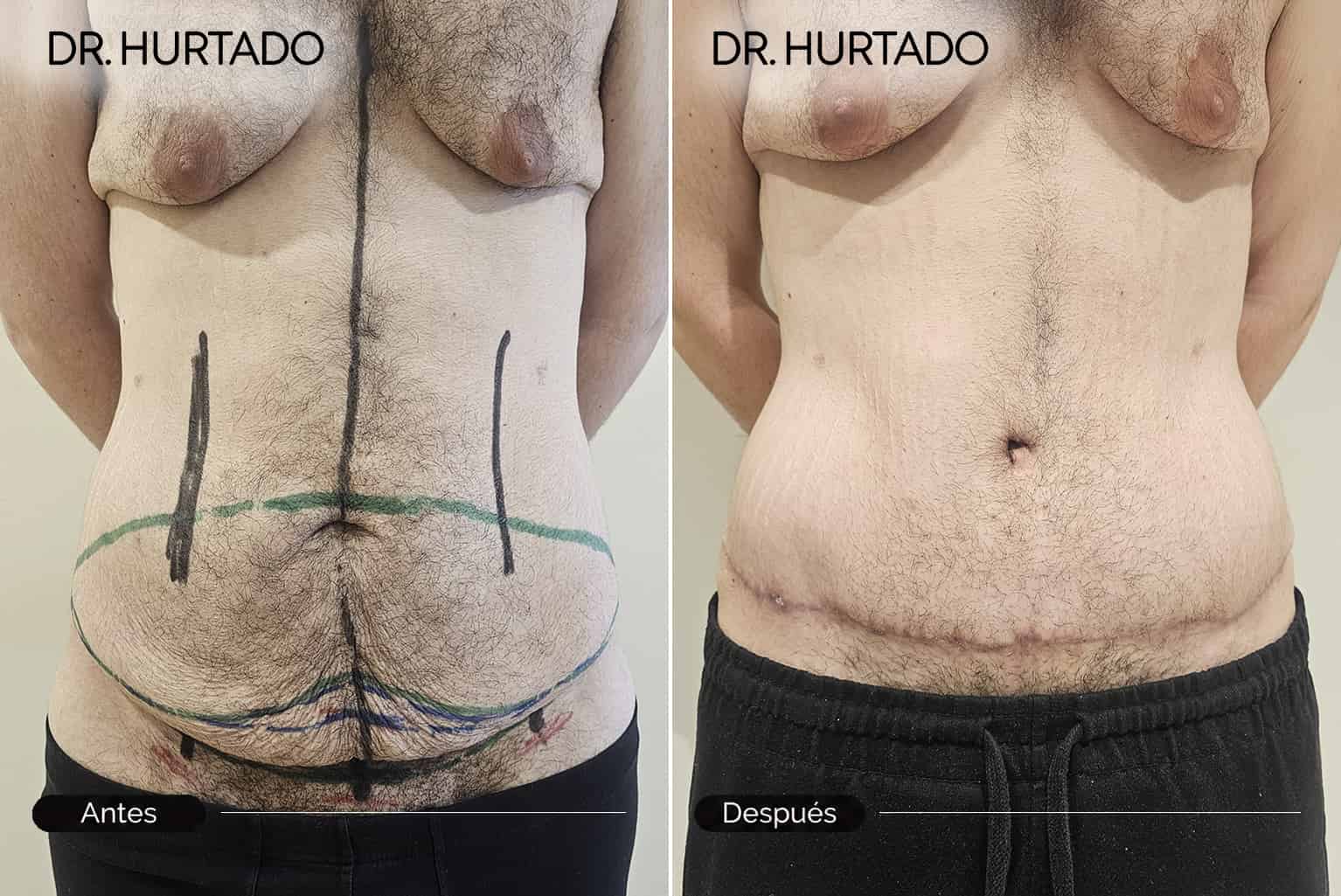 Abdominoplastia antes y después en Galicia