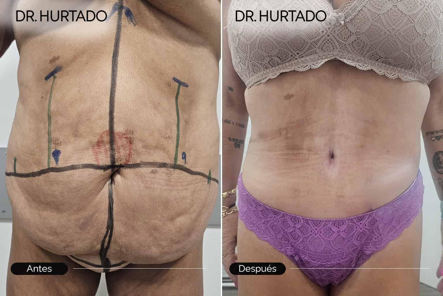 Resultados de abdominoplastia en Galicia