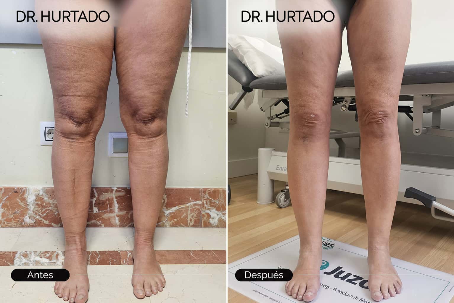 Tratamiento quirúrgico del lipedema