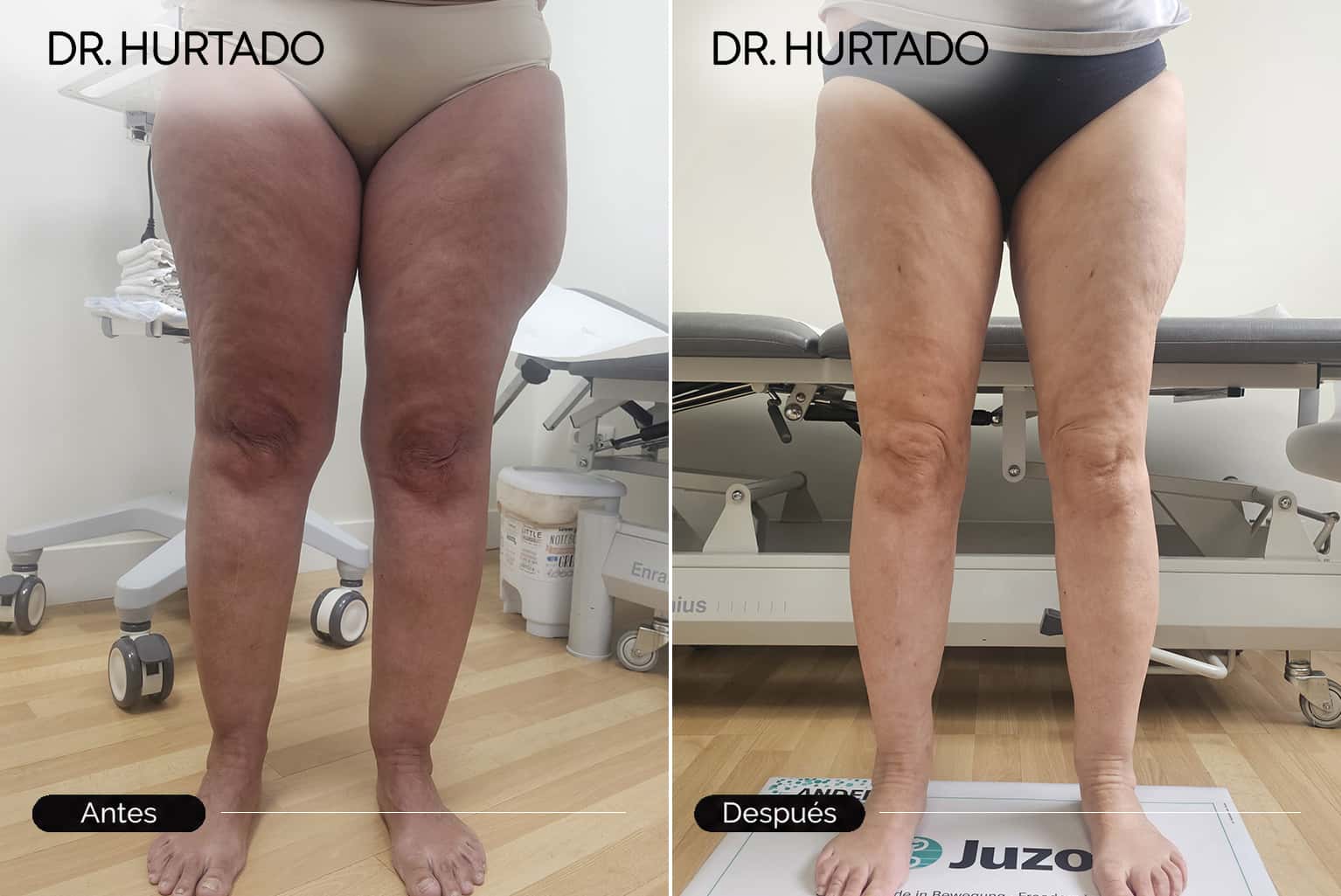 Cirugía de lipedema en piernas