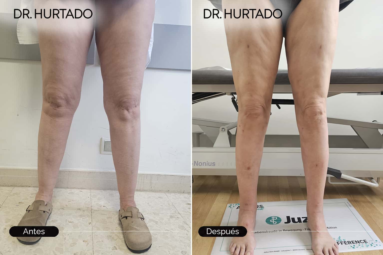 Cirugía especializada para el lipedema