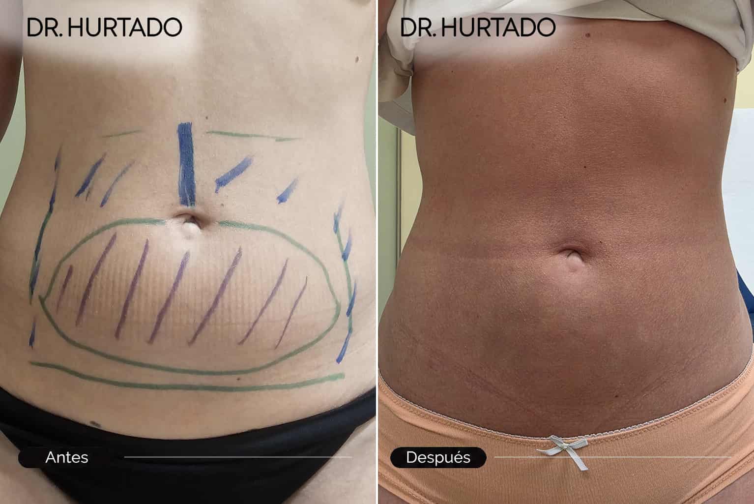 Tratamiento de lipoescultura en Galicia