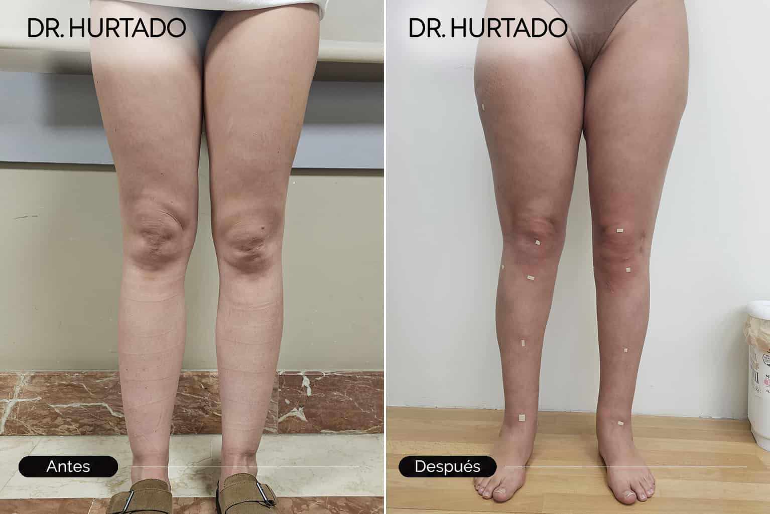Lipoescultura antes y después en Galicia