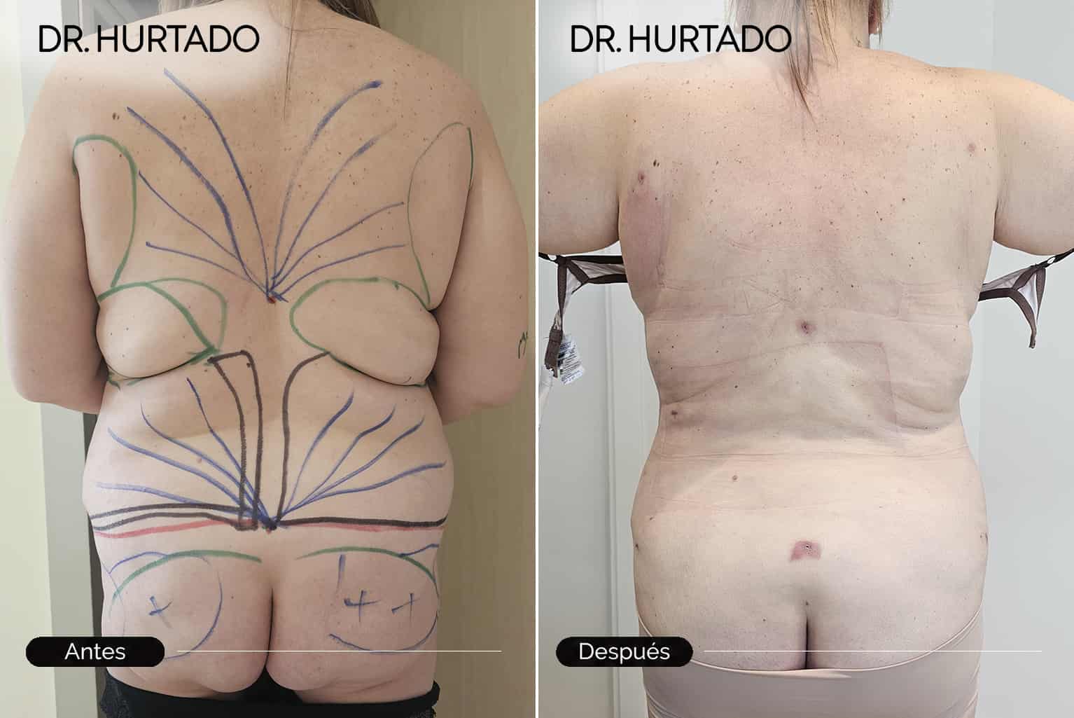 Resultados de lipoescultura en Galicia